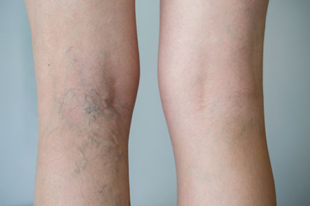 Spider veins t can be treated with sclerotherapy